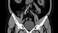 Acute appendicitis (Radiopaedia 13030-13091 Coronal non-contrast 12).jpg