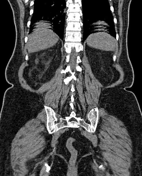 File:Acute appendicitis (Radiopaedia 58627-65818 Coronal non-contrast 54).jpg