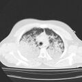 Acute aspiration pneumonitis (Radiopaedia 33605-34703 Axial lung window 31).jpg