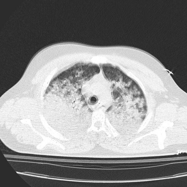 File:Acute aspiration pneumonitis (Radiopaedia 33605-34703 Axial lung window 31).jpg