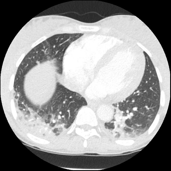 File:Acute chest syndrome - sickle cell disease (Radiopaedia 42375-45499 Axial lung window 136).jpg