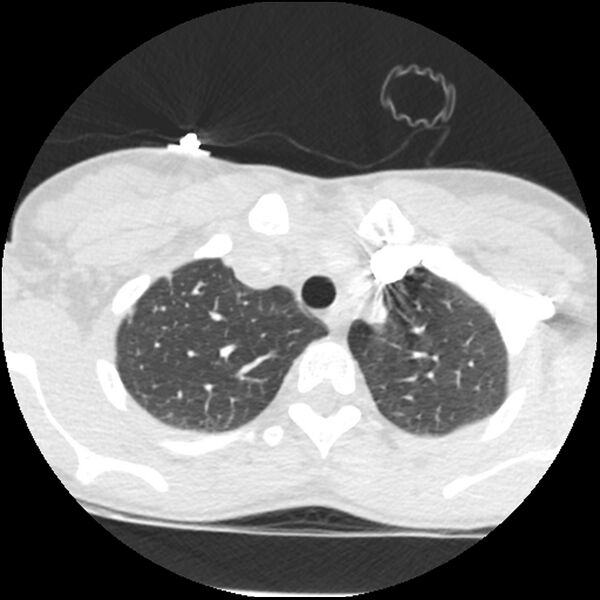 File:Acute chest syndrome - sickle cell disease (Radiopaedia 42375-45499 Axial lung window 39).jpg