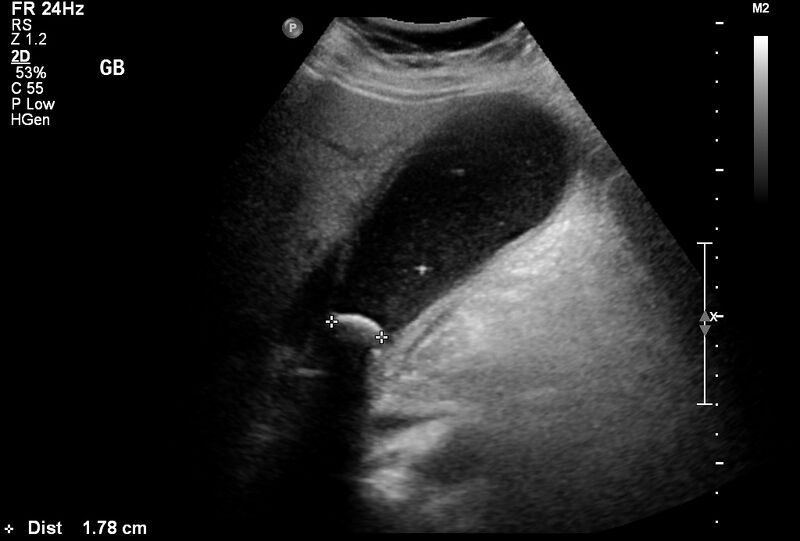 File:Acute cholecystitis and ureteric colic (Radiopaedia 42330-45445 Gallbladder 1).jpg
