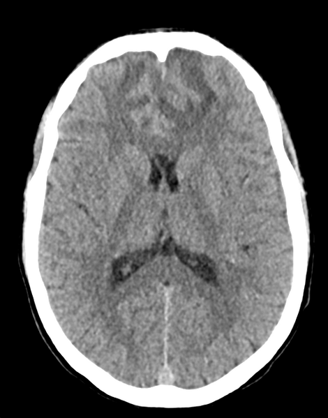 File:Acute disseminated encephalomyelitis (ADEM) (Radiopaedia 65319-74348 Axial non-contrast 18).png