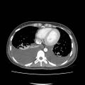 Acute myocarditis (Radiopaedia 55988-62613 Axial C+ portal venous phase 2).jpg