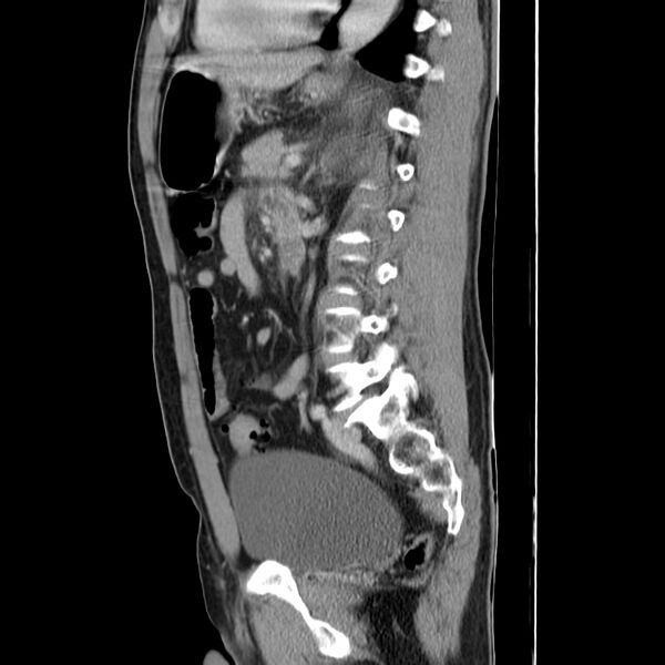 File:Acute pancreatitis (Radiopaedia 22572-22596 Sagittal C+ portal venous phase 33).jpg