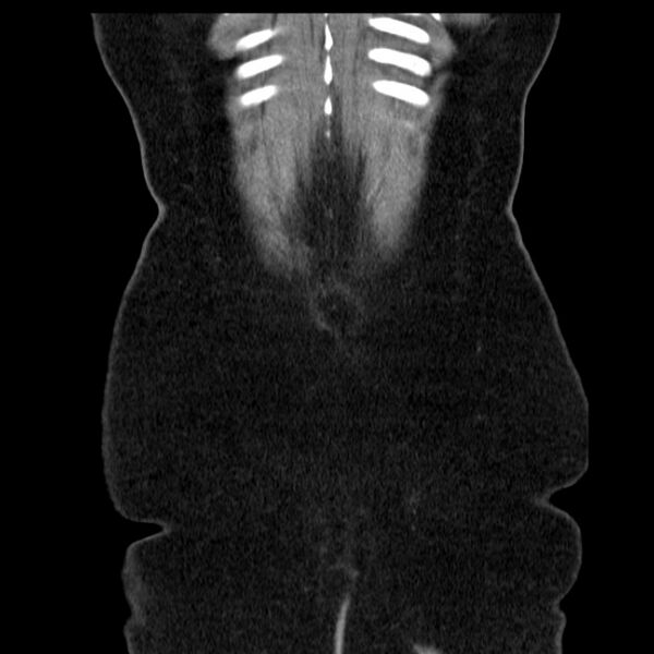 File:Acute pancreatitis - Balthazar C (Radiopaedia 26569-26714 Coronal C+ portal venous phase 66).jpg
