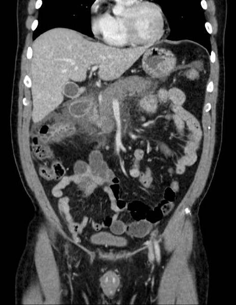 File:Acute pancreatitis - Balthazar E (Radiopaedia 23080-23110 Coronal C+ portal venous phase 28).jpg