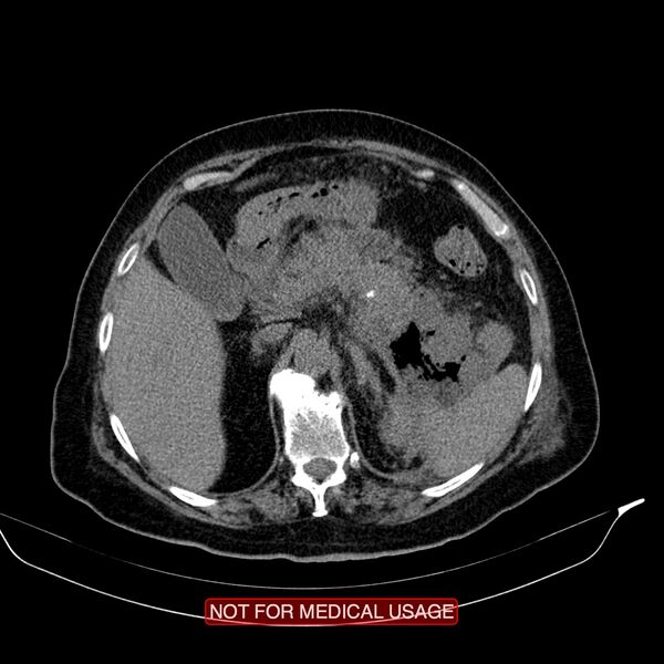 File:Acute pancreatitis with infected necrosis (Radiopaedia 26454-26585 Axial non-contrast 8).jpg