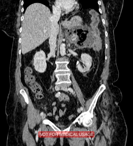 File:Acute pancreatitis with infected necrosis (Radiopaedia 26454-26585 Coronal C+ portal venous phase 1).jpg