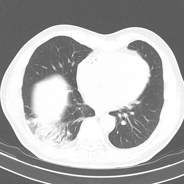 File:Acute pulmonary embolism (Radiopaedia 81677-95570 Axial lung window 31).jpg