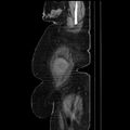 Acute pyelonephritis (Radiopaedia 25657-25837 Sagittal renal parenchymal phase 13).jpg