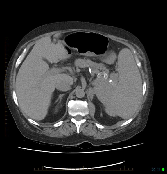 File:Acute renal failure post IV contrast injection- CT findings (Radiopaedia 47815-52559 Axial C+ portal venous phase 23).jpg