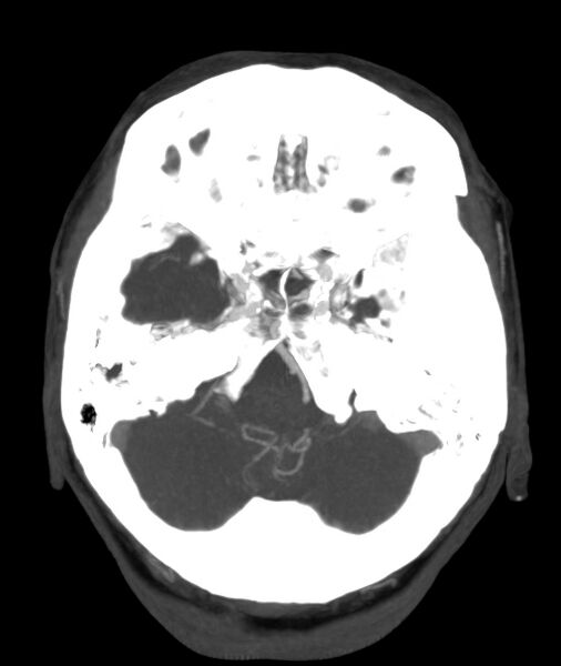 File:Acute right MCA M1 occlusion (Radiopaedia 62268-70454 Axial Phase 1 23).jpg