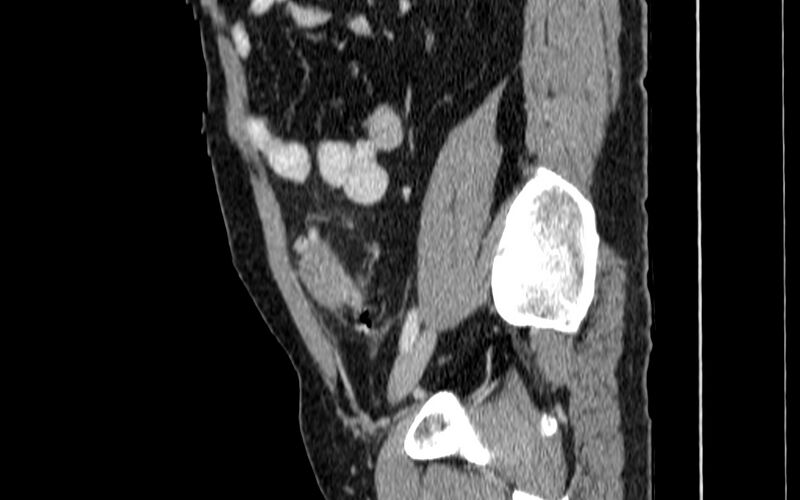 File:Acute sigmoid colon diverticulitis (Radiopaedia 55507-61976 Sagittal C+ portal venous phase 63).jpg