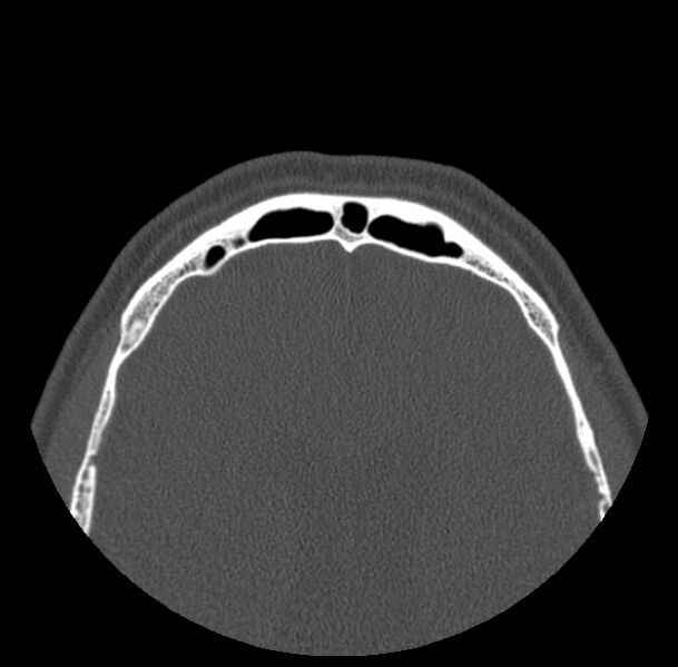 File:Acute sinusitis (Radiopaedia 23161-23215 Axial bone window 74).jpg