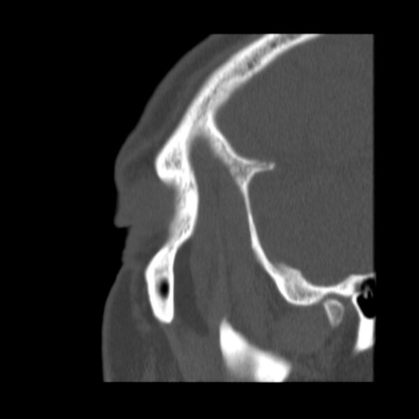 File:Acute sinusitis (Radiopaedia 23161-23215 Sagittal bone window 56).jpg