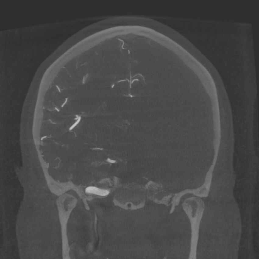 Acute subarachnoid hemorrhage and accessory anterior cerebral artery (Radiopaedia 69231-79010 Coronal arterial - MIP 55).jpg