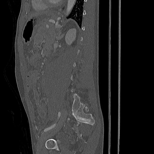 File:Acute vertebral body compression fractures (Radiopaedia 31757-32693 Sagittal bone window 8).jpg