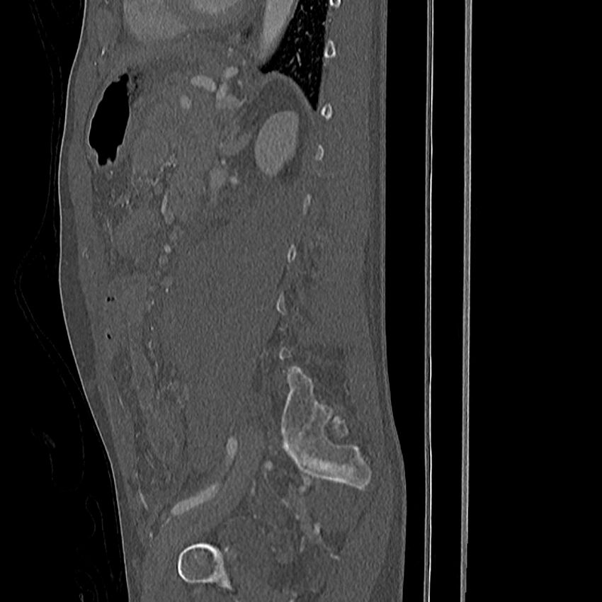 Acute vertebral body compression fractures (Radiopaedia 31757-32693 Sagittal bone window 8).jpg