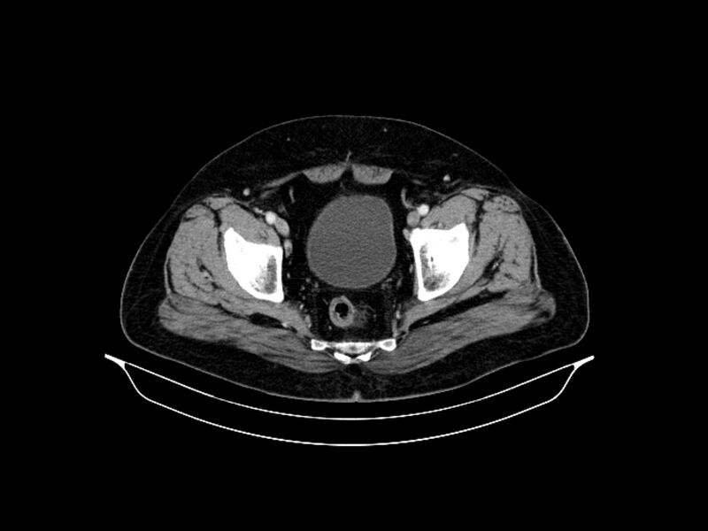 File:Adenocarcinoma of pancreas with hepatic metastasis (Radiopaedia 64332-73122 Axial C+ portal venous phase 91).jpg
