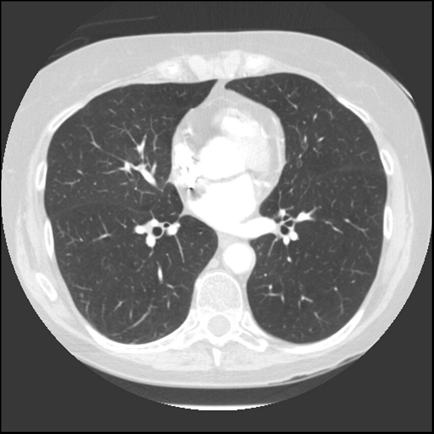 Adenocarcinoma of the lung (Radiopaedia 41015-43755 Axial lung window 71).jpg
