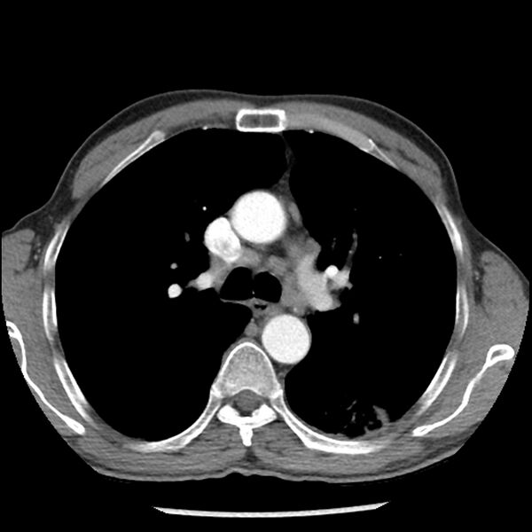 File:Adenocarcinoma of the lung - micropapillary predominant (Radiopaedia 42446-45563 Axial C+ portal venous phase 27).jpg