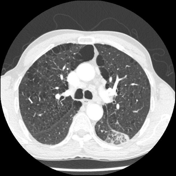 File:Adenocarcinoma of the lung - micropapillary predominant (Radiopaedia 42446-45563 C 14).jpg