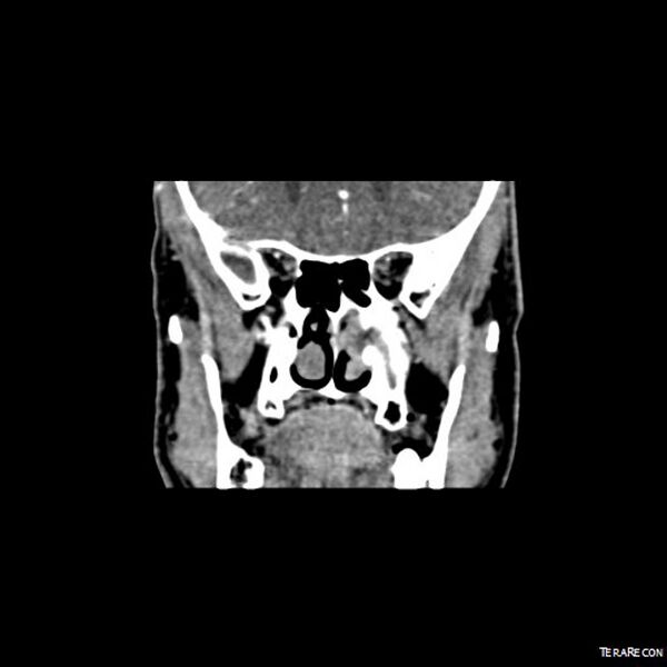 File:Adenoid cystic carcinoma involving paranasal sinus (Radiopaedia 16580-16283 Coronal C+ arterial phase 2).jpeg