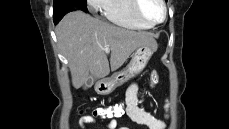 File:Adenomyomatosis of the gallbladder (Radiopaedia 12142-12483 Coronal C+ arterial phase 8).jpg