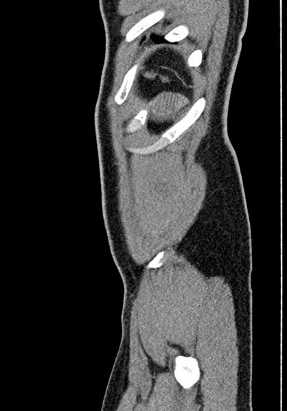 File:Adhesional small bowel obstruction (Radiopaedia 58900-66131 Sagittal C+ portal venous phase 235).jpg