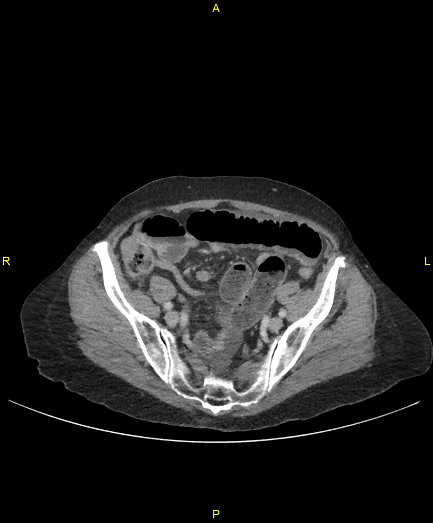 Adhesional small bowel obstruction (Radiopaedia 85402-101024 Axial C+ portal venous phase 220).jpg