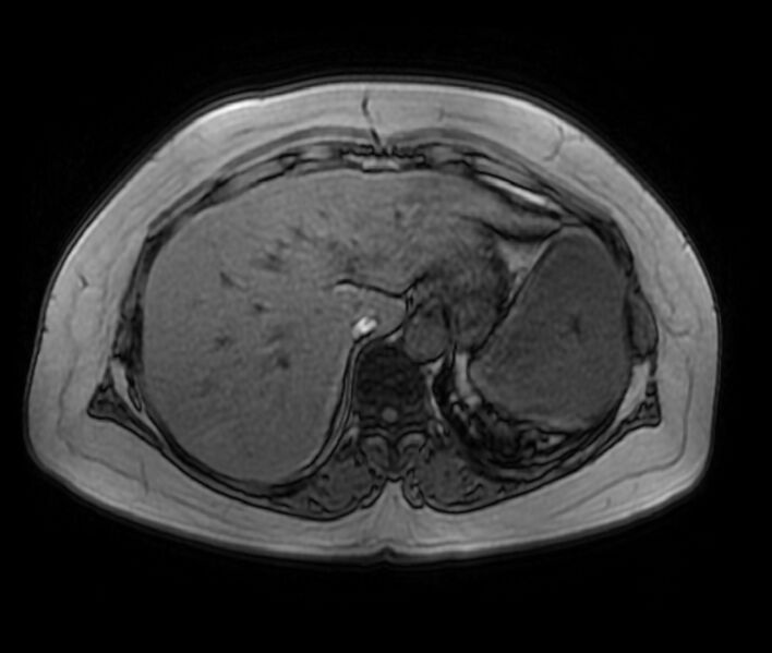 File:Adrenal cortical carcinoma (Radiopaedia 70906-81116 Axial T1 in-phase-out-of-phase 9).jpg