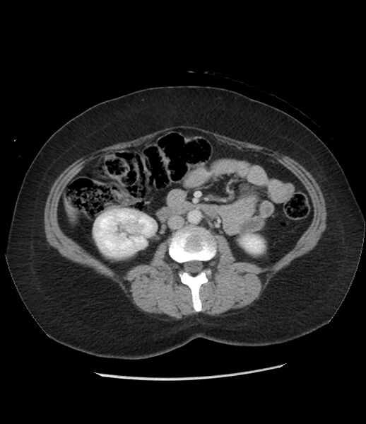 File:Adrenal cortical carcinoma with IVC invasion and thrombosis (Radiopaedia 34307-35597 Axial C+ portal venous phase 44).jpg