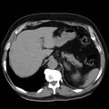 Adrenal hemangioma (Radiopaedia 11039-11445 Axial non-contrast 1).jpg