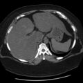 Adrenal myelolipoma (Radiopaedia 8216-9068 Axial non-contrast 1).jpg