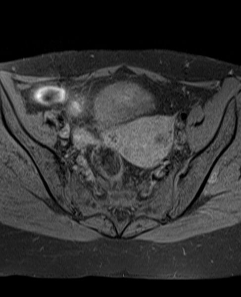 File:Adult granulosa cell tumor of the ovary (Radiopaedia 71581-81950 Axial T1 fat sat 12).jpg