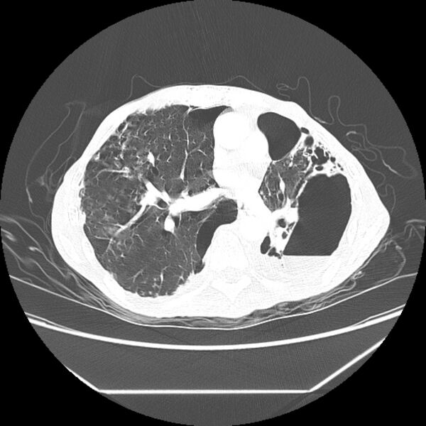 File:Advanced pulmonary tuberculosis (Radiopaedia 8599-9431 Axial lung window 28).jpg