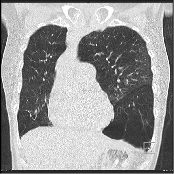 File:Alpha-1-antitrypsin deficiency (Radiopaedia 26537-26678 Coronal lung window 9).jpg