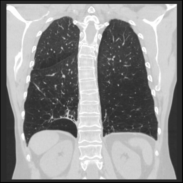 File:Alpha-1-antitrypsin deficiency (Radiopaedia 40993-43722 Coronal lung window 79).jpg
