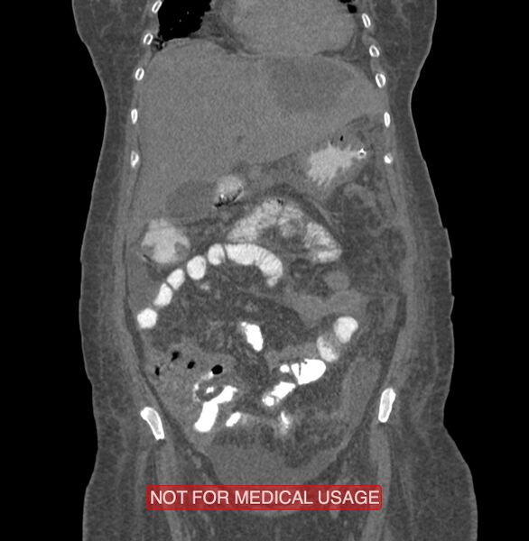 File:Amoebic enterocolitis with liver abscess (Radiopaedia 35100-36609 B 52).jpg