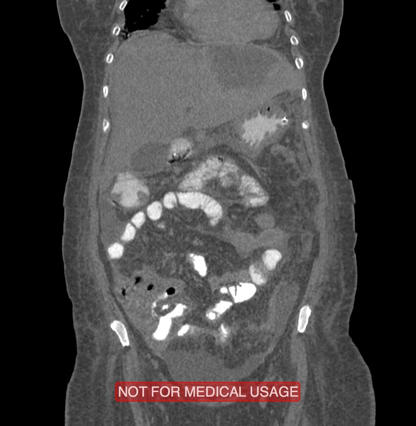 Amoebic enterocolitis with liver abscess (Radiopaedia 35100-36609 B 52).jpg