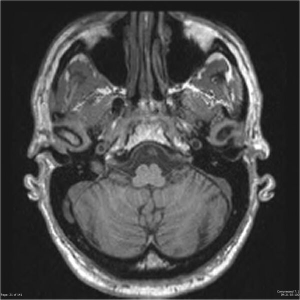 File:Anaplastic meningioma with recurrence (Radiopaedia 34452-35788 Axial T1 19).jpg