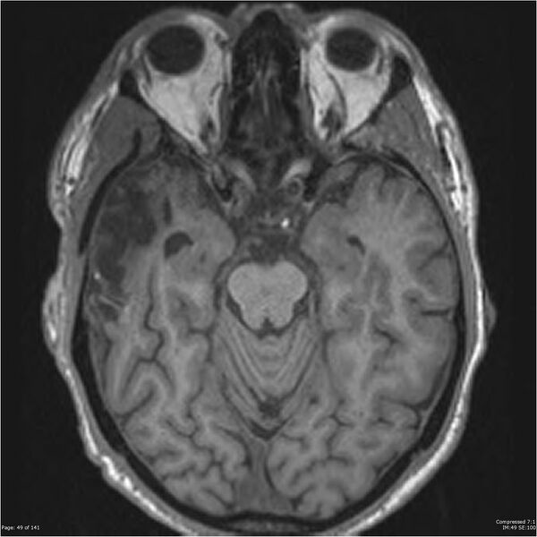 File:Anaplastic meningioma with recurrence (Radiopaedia 34452-35788 Axial T1 47).jpg