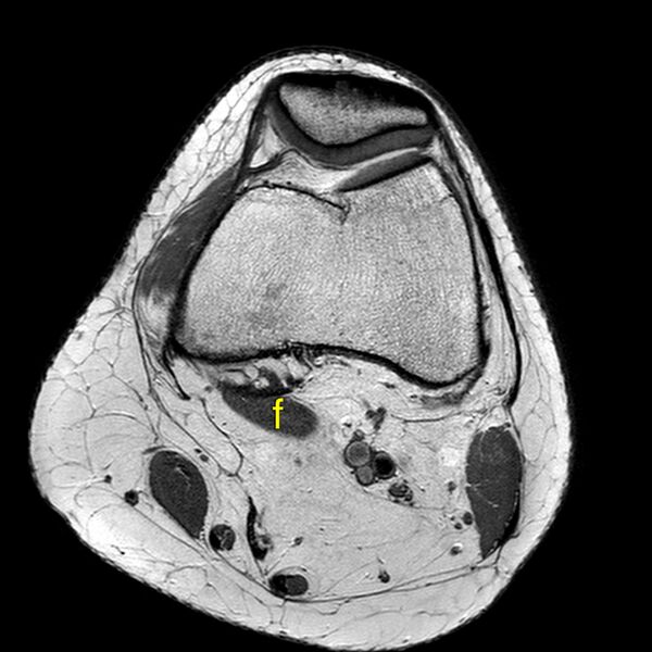 File:Anatomy Quiz (MRI knee) (Radiopaedia 43478-46866 A 7).jpeg