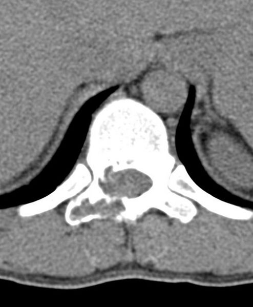 File:Aneurysmal bone cyst T11 (Radiopaedia 29294-29721 Axial non-contrast 41).jpg