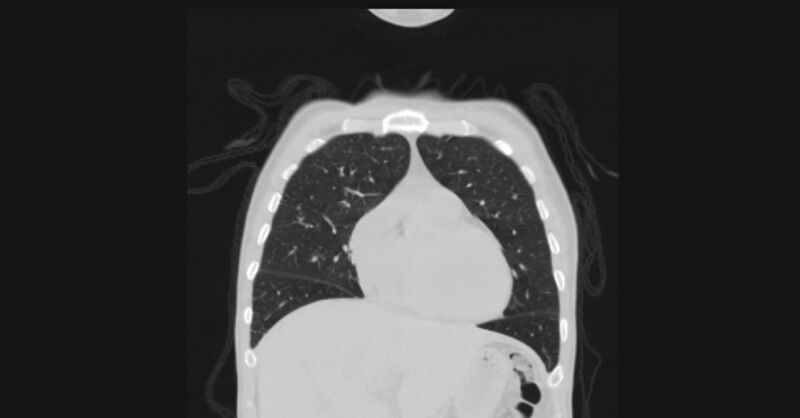 File:Angioinvasive aspergellosis (Radiopaedia 66995-76315 Coronal lung window 16).jpg