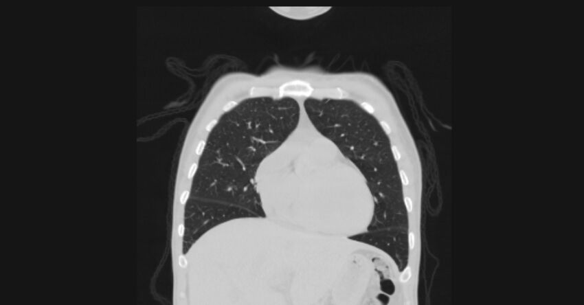 Angioinvasive aspergellosis (Radiopaedia 66995-76315 Coronal lung window 16).jpg