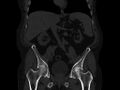 Ankylosing spondylitis (Radiopaedia 44609-48357 Coronal bone window 31).jpg