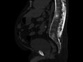 Ankylosing spondylitis (Radiopaedia 44609-48357 Sagittal bone window 56).jpg
